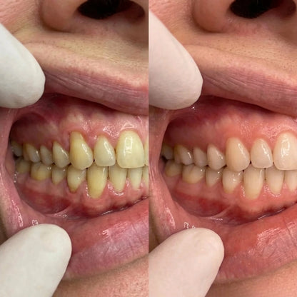 ELORYA GumRestore